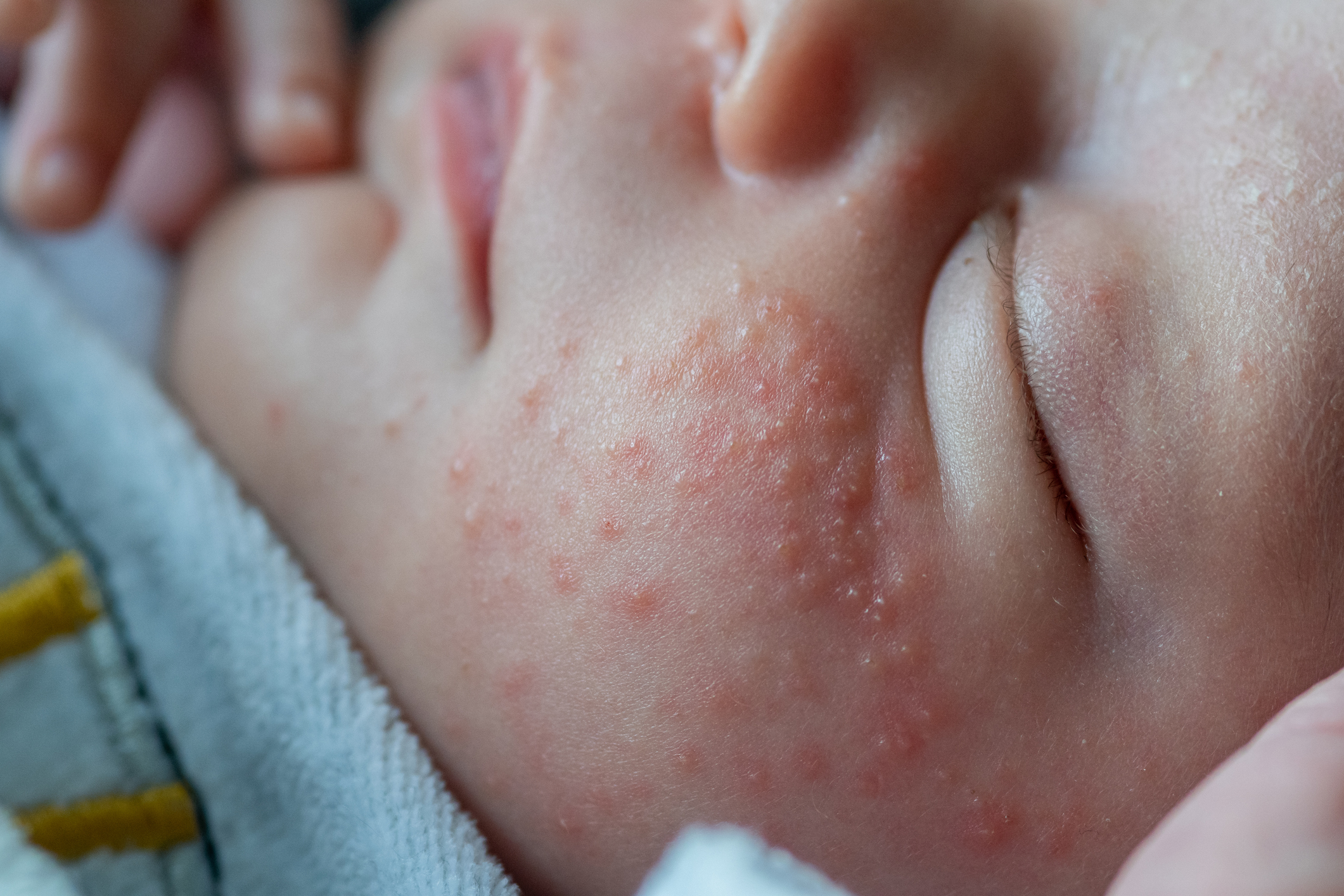 Baby acne