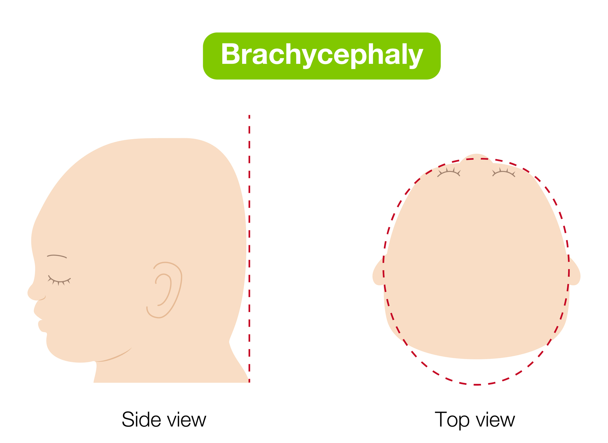 Brachycephaly