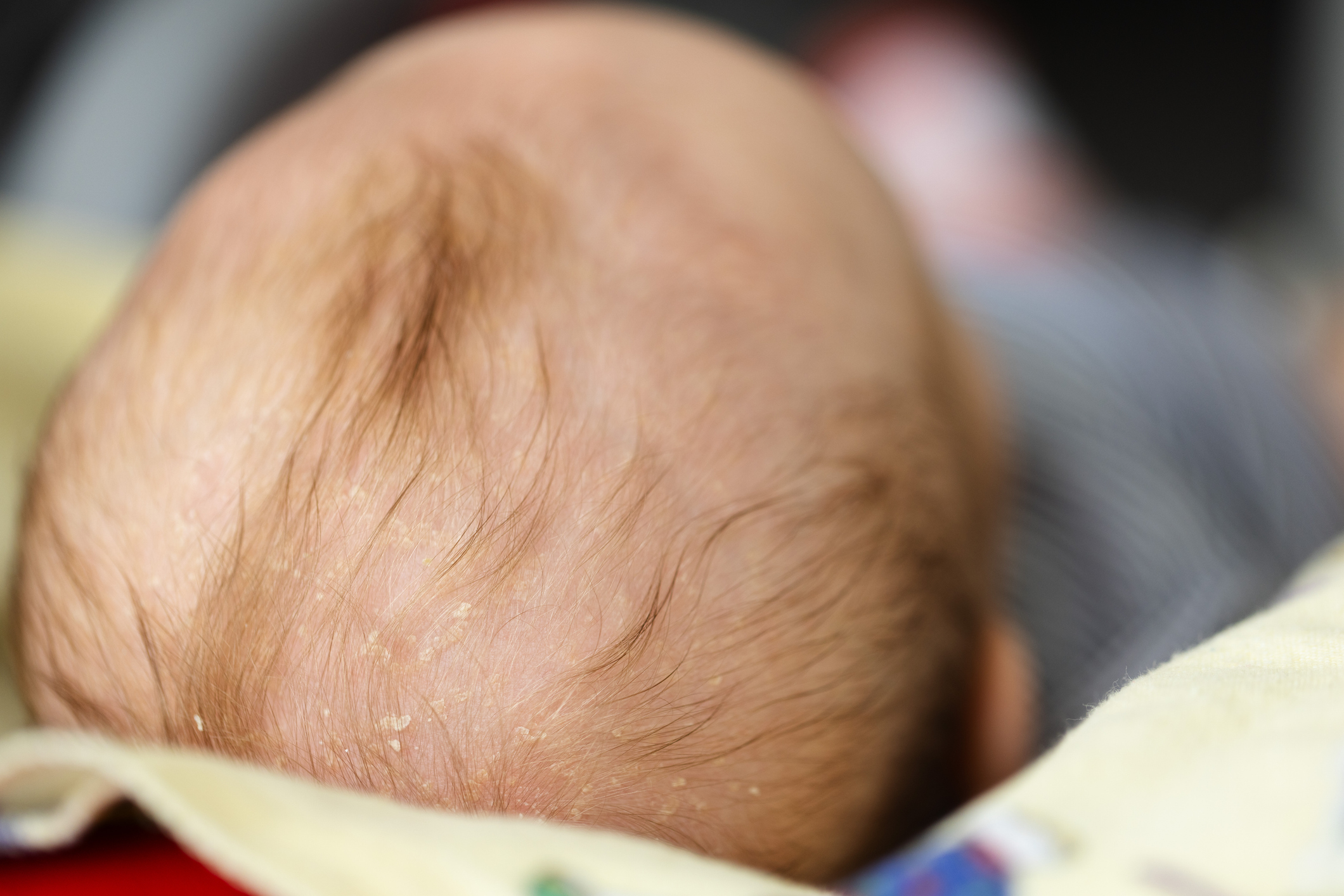 Cradle cap