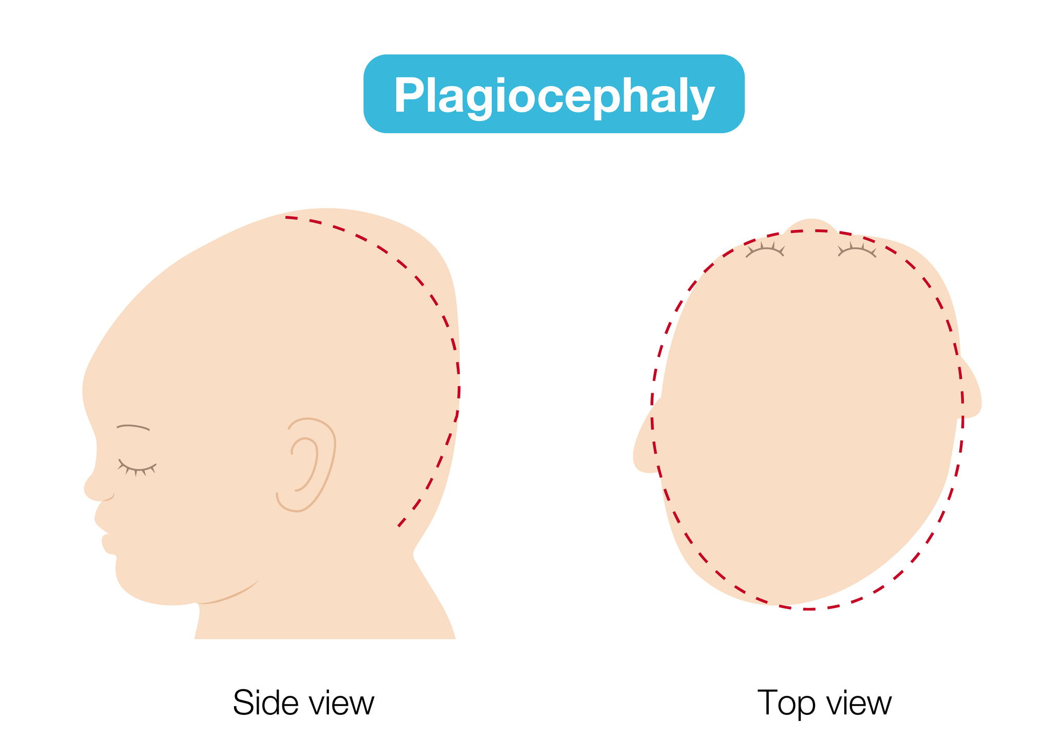 Plagiocephaly