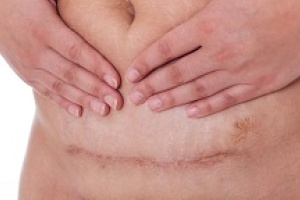 c-section scar
