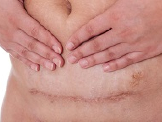 c-section scar