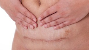 c-section scar